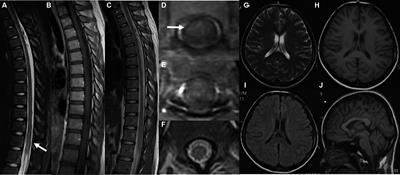 Combined central and peripheral demyelination: a case report resembling encephalomyeloradiculoneuropathy